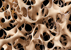 Osteoporoosi korral